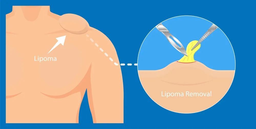 脂肪瘤|千万次地问：脂肪瘤会恶变吗？