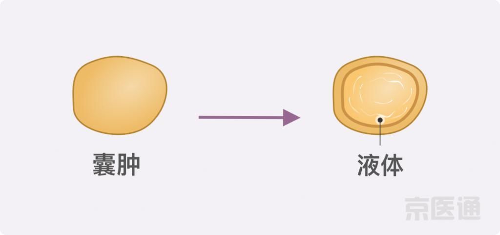 癌症|结节、息肉、囊肿是癌症先兆吗？北肿专家们说出了真相！