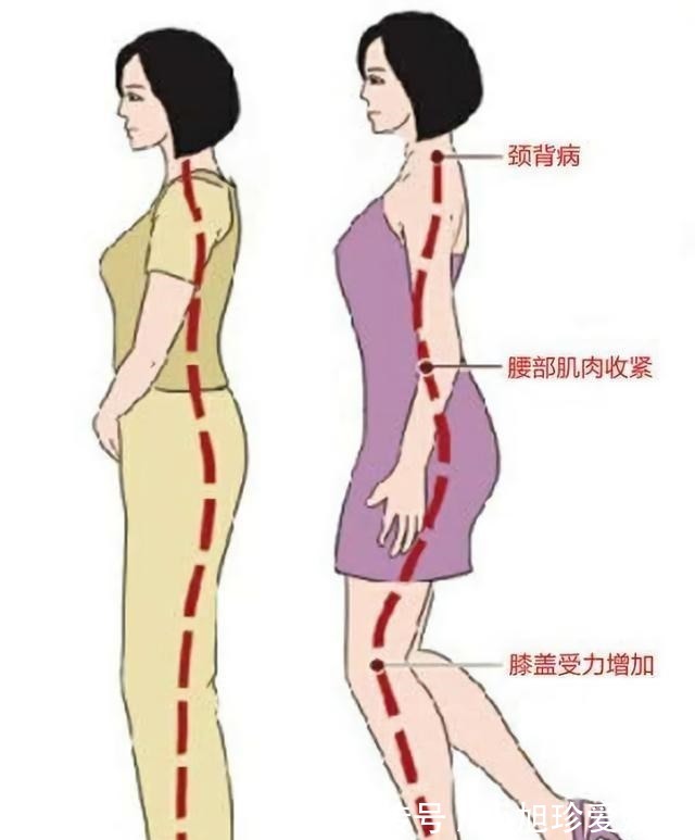 拇囊炎|穿高跟鞋的危害到底有多大？