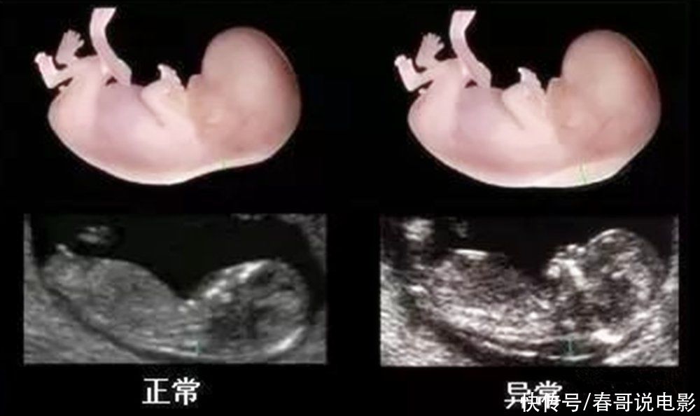 检查|孕妈不想生下“傻孩子”，孕期几项产检要按时做，忽视不得