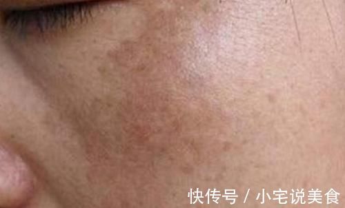 黑色素|一块钱的红霉素软膏，怎么成了“淡斑专家”？听听医生怎么说