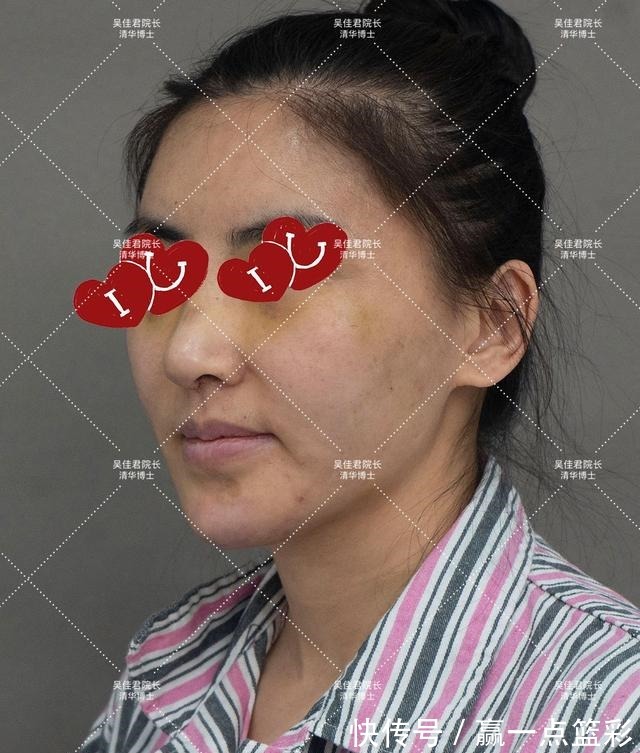 手术 40多岁大姐小拉皮手术全过程分享!