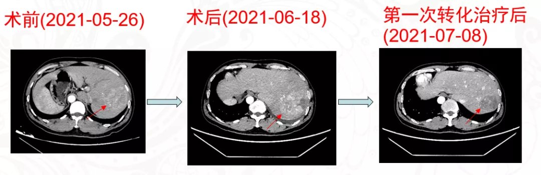 广西医科大学|广西一男子内脏全长反，还患肝癌！看医生如何化解手术风险