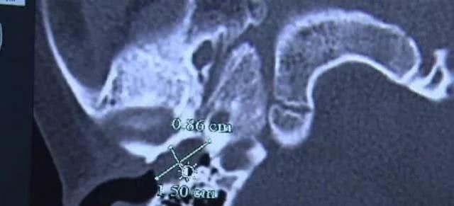 耳垢|五岁男孩出生起就没有掏过耳垢结果他第一次掏,花了5000元