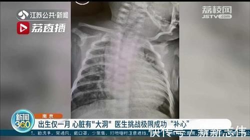 切口|一个月大的婴儿心脏查出有个“大洞”医生挑战极限成功“补心”