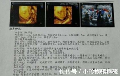 怀孕|怀孕最后一个月,胎儿能长多少斤?不清楚的孕妈,了解下比较好!