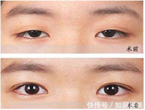 并发症 上睑下垂术后多久恢复自然?其实这1点才更该重视