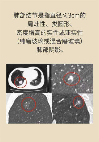 治疗|如何尽早确定肺结节治疗方案？1024靶扫描了解一下