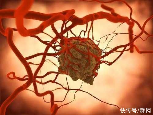 对照|怎样才能不得癌症呢?有这五个特征的人大多永远不会的癌症，快来对照一下