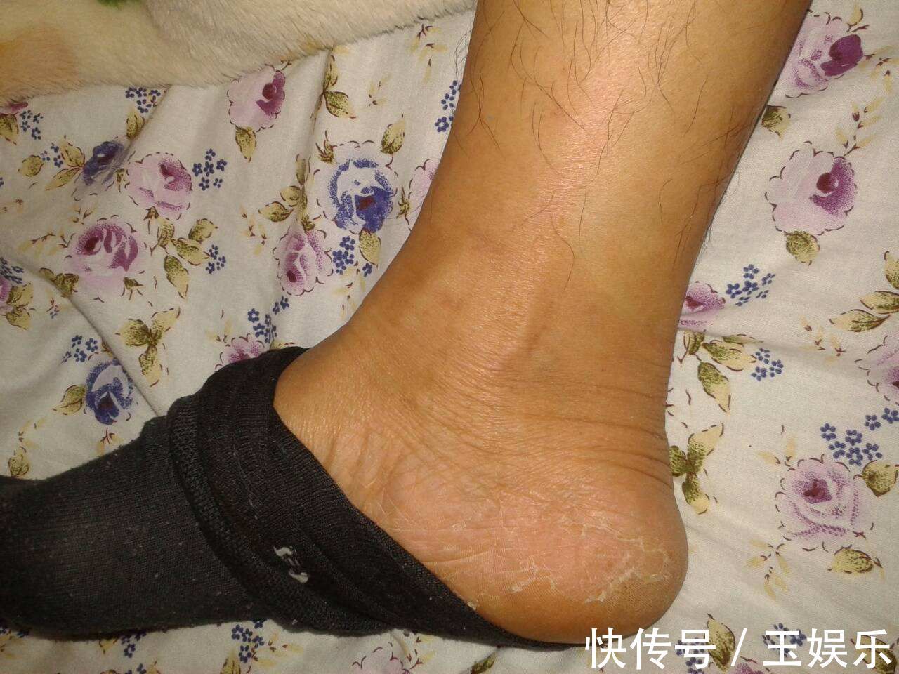 三高|脚出现三大症状就要当心了,可能是糖尿病足来了