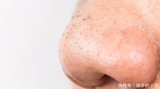 皮脂|黑头反反复复那是因为你用错了方法