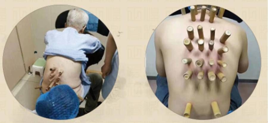 痰浊|探秘中医非遗?丨金匮正脊六联疗法对椎管狭窄的解读