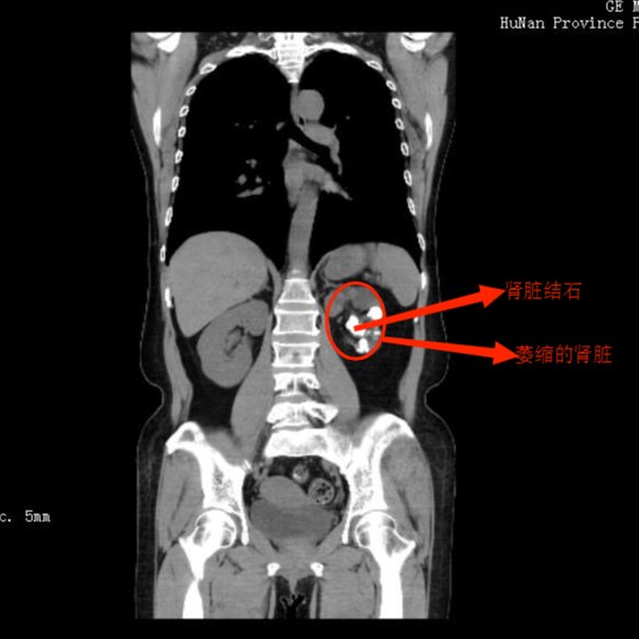 泌尿外科|不痛的结石更可怕，女子患结石十余年毁掉一个肾