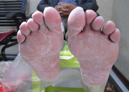 慢性疾病|医生提示:糖尿病患者在出现糖尿病足时,早期一般有这3大症状