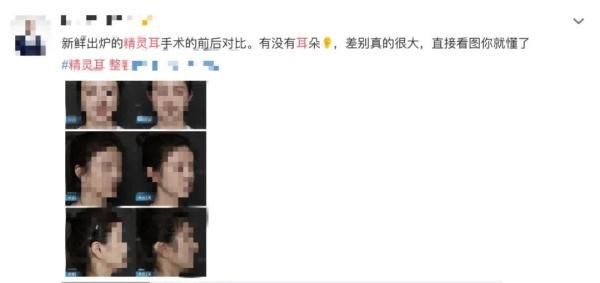 李钢|整形成“精灵耳”显脸小？专家：可能显脸更大