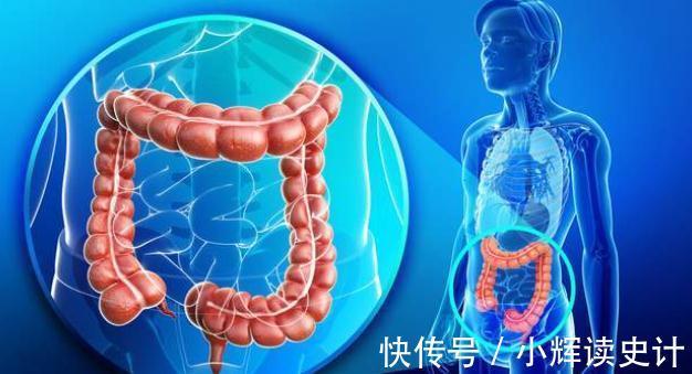 肠癌|95%的肠癌是息肉惹的祸!这样做轻松阻断它的癌变之路!