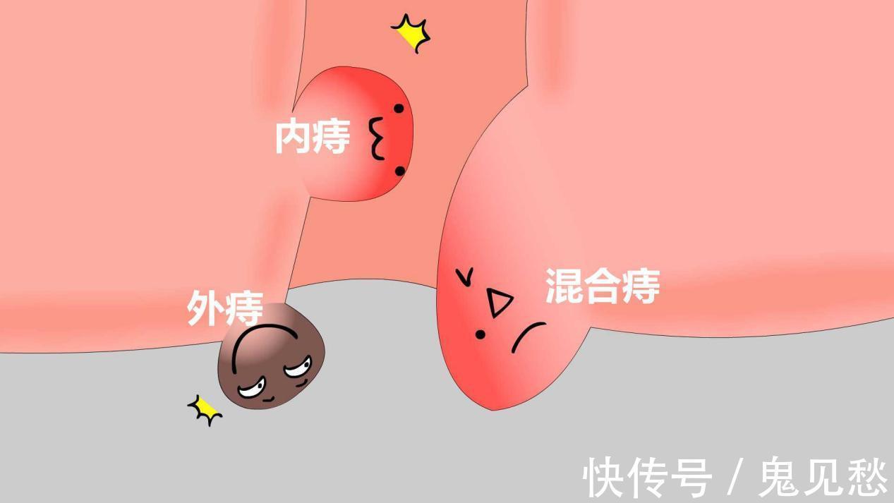 内痔|肛肠专家告诉你:痔疮如何用药,痔疮用什么药好?