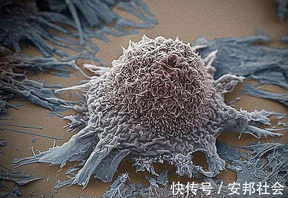 根治性|明明是肺癌早期做了根治性手术,不久就复发转移了,到底什么原因