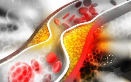 腦梗的“罪魁禍首”被揪出,醫生這2類食物再饞也要管住嘴