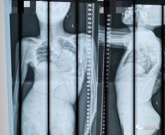 心理健康|14岁少年患这个病面临瘫痪，医生提醒：这些症状需重视！