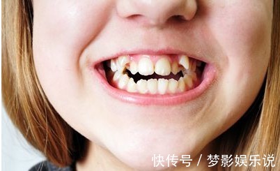 矫正|儿童做牙齿矫正三个最佳时间:家长要牢记,矫治越早干预效果越好