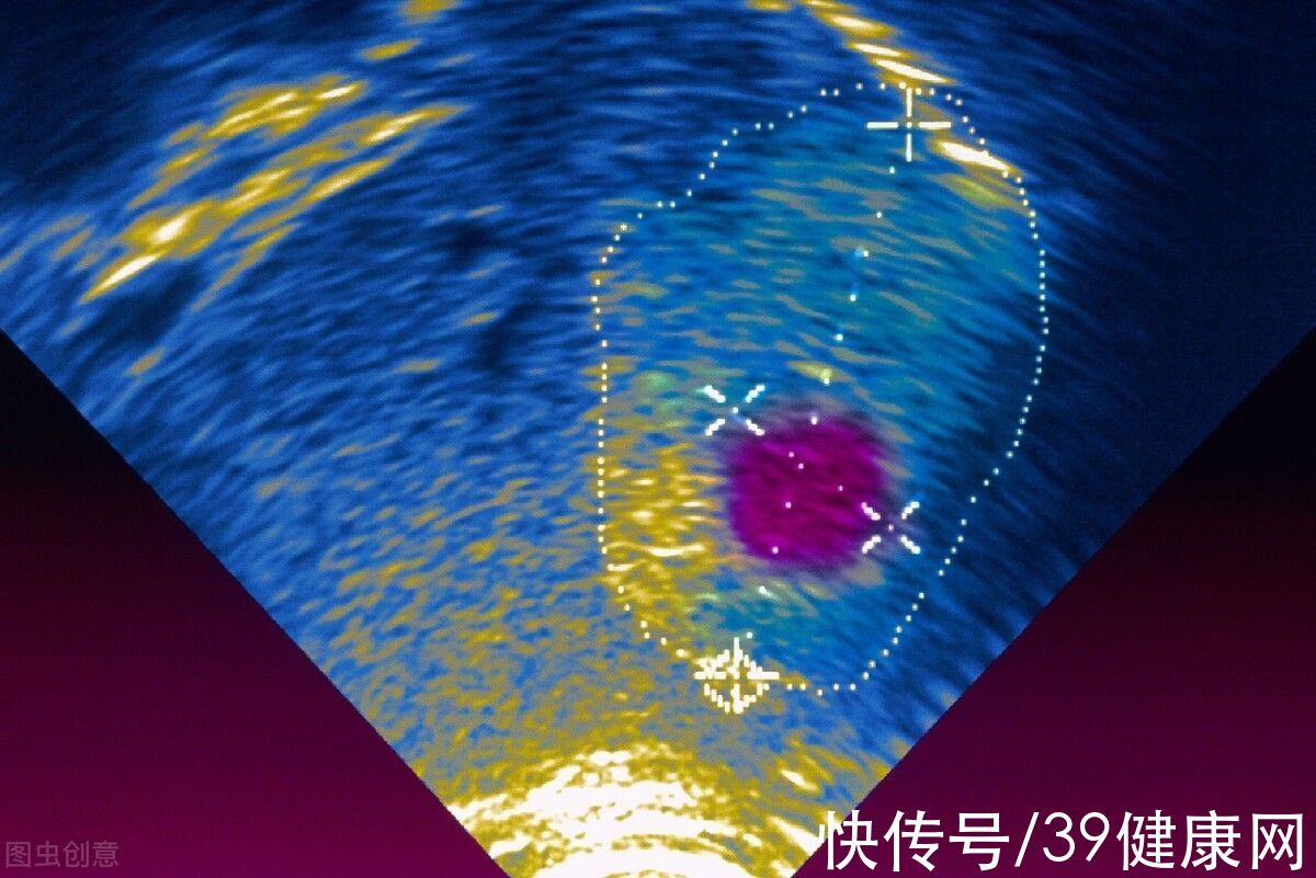 癌变|体检查出囊肿、结节、息肉是癌症先兆？要不要切？很多人都搞错了