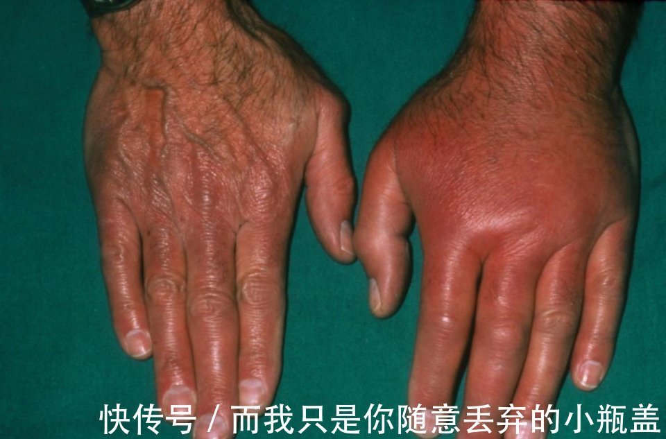 源头|降尿酸,要控制好源头,嘌呤只是表象,做好2点有助远离痛风