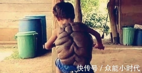 男孩|8岁男孩背上长出惊人大“龟壳”，酷似忍者神龟
