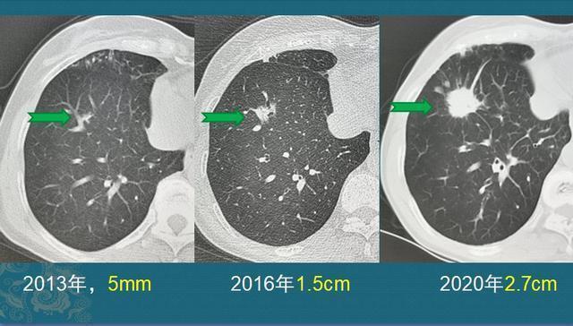 黄勇|肺腺癌是怎么长出来的医生介绍3类肺结节，像种子发芽