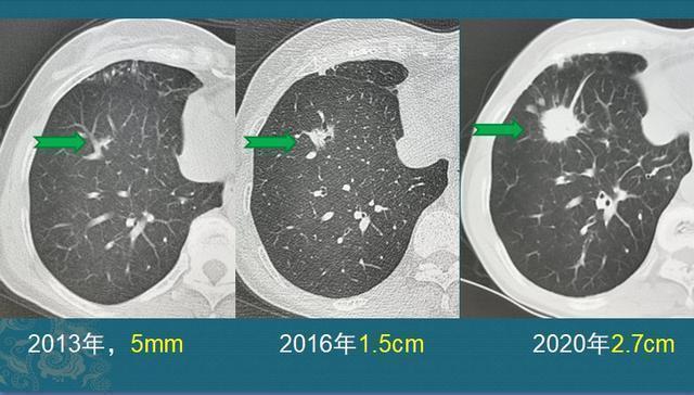黄勇|肺腺癌是怎么长出来的医生介绍3类肺结节,像种子发芽