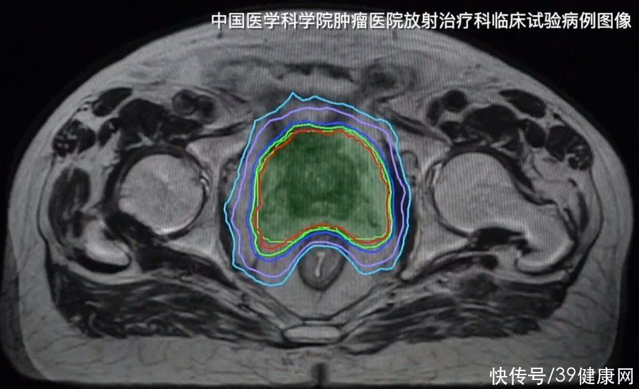  正式|抗癌效果显著！国内正式引入抗癌“导弹”，能追着肿瘤精准打击