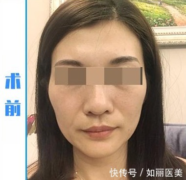 周女士 45岁女士拉皮手术便签记录“曝光”,脸好像小了一圈