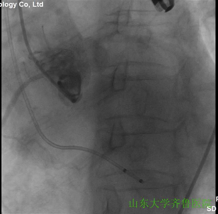 患者|省内首例!齐鲁医院完成一站式经导管主动脉瓣置换术(TAVR)+经皮二尖瓣球囊扩张成形术(PBMV)