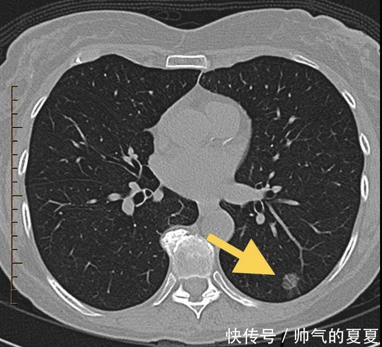 有肺结节的人，都值得看一看