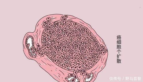 肺癌转移率有多大呼吸科医生3个部位易被攻击,留意异常表现