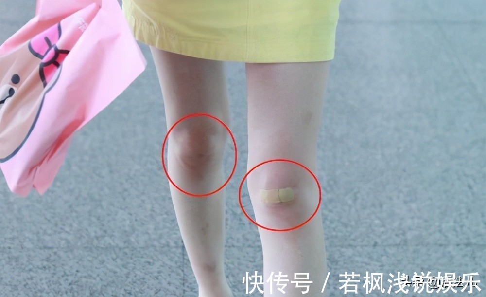 半月板|膝盖痛不是因为冷,而是因为这5件事!学会1招,拯救你受伤的关节