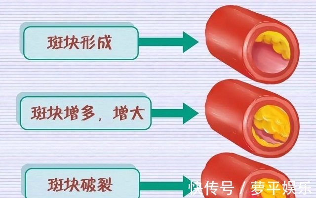 检查|引发心梗的高血脂,应该检查哪些指标