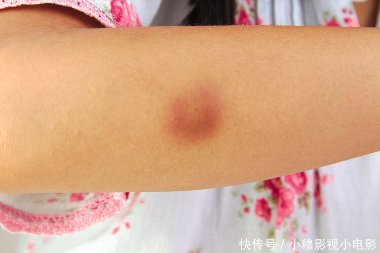 医院|身上无缘无故有淤青,很可能是肝不好!医生提醒:快去医院检查