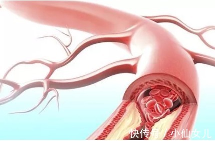 冠状动脉|关于冠心病你了解多少?心脑血管专家郭兰为你专业解答