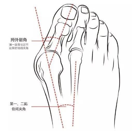 跖趾关节|80岁老人患上“拇外翻”，南医大逸夫医院骨科手术帮老人成功矫正畸形