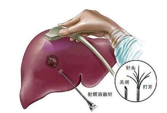 b超检查|肝脏肿瘤早知1年，寿命也许延长10年，肝脏病变的信号，要牢记!
