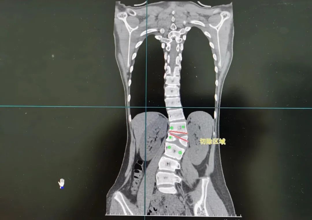 手术|十堰13岁女孩坐下时，家人发现不对劲！医生：要截骨