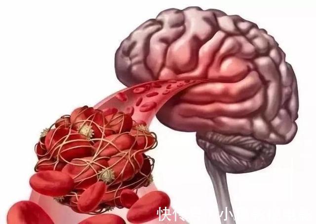 动脉硬化|2022“新血压标准”已公布,不再是120/80mmHg,高血压患者应了解