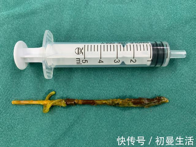 熊孩子|13岁男孩反复腹痛3个月!“熊孩子”你到底吞了个啥