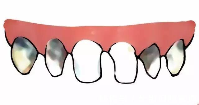 奶瓶龋|口腔科普：宝宝嘴里的“奶瓶龋”