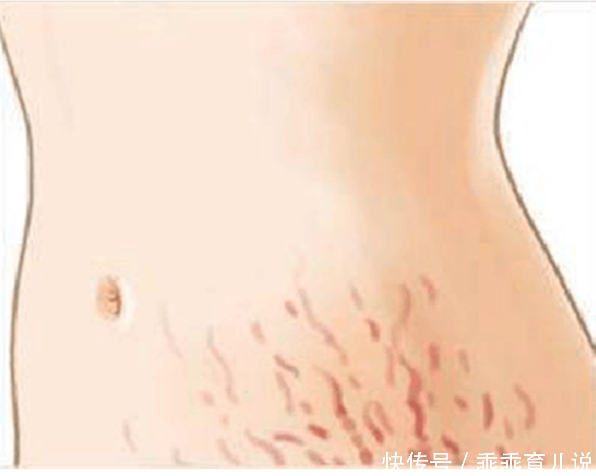 演绎|怀孕时,妊娠纹是怎么长出来的?医生的演绎很形象,一般人不知道