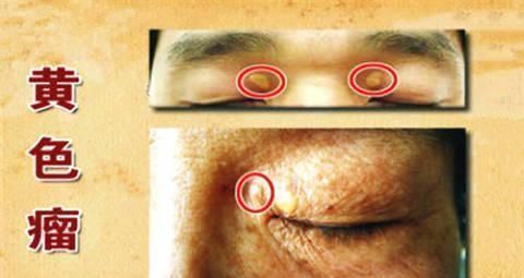 降血脂的“冠军”找到了,搭配水一起喝,血管干净、血脂降下来了