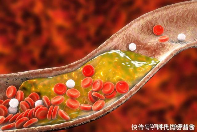 甘油三酯“害怕”1物,并不是洋葱,饭后吃一点,血脂或悄悄降