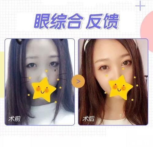 肿泡眼福音,到底怎么割,才不会出现肉条感