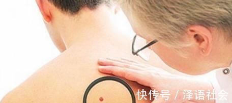 红痣|身上突然长了很多小红痣，是什么原因？其中1个需警惕，不可忽视